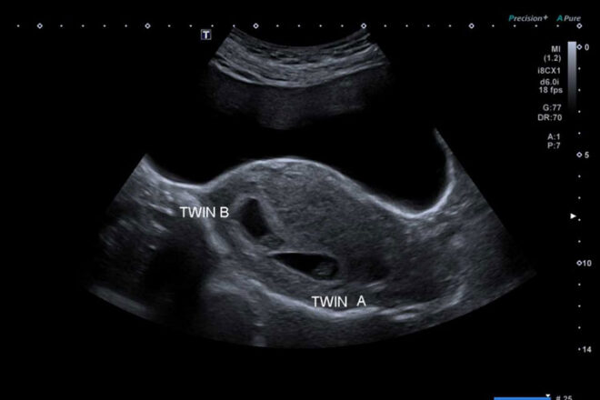 Rebecca's twin ultrasound DCDA twins