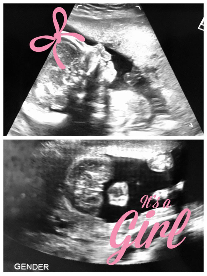 Jackie's ultrasound confirming gender