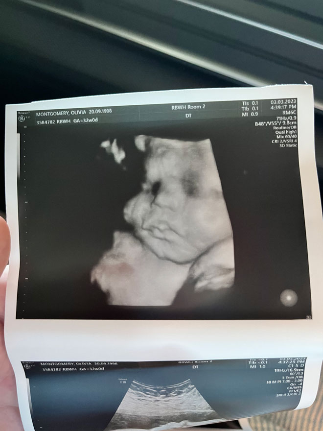 An ultrasound pic of a baby