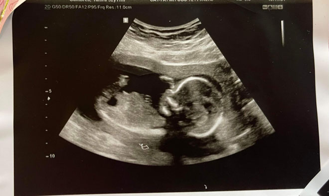 An ultrasound photo of a baby