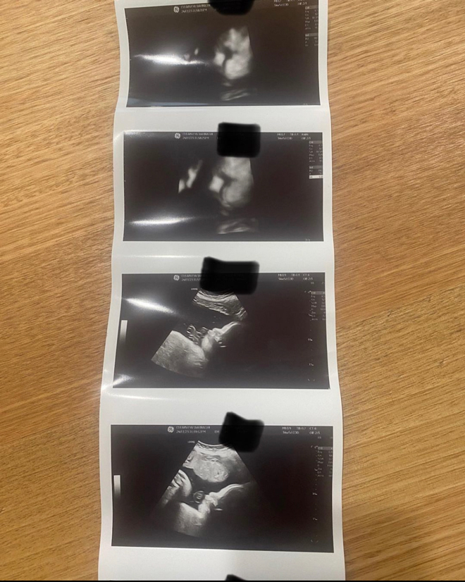 ultrasound images at 20 weeks gestation