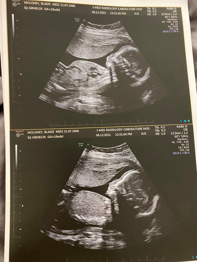 a pregnancy ultrasound photo