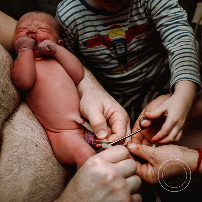 A baby’s umbilical cord being cut