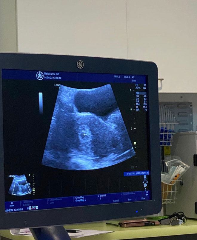 Embryo transfer ultrasound