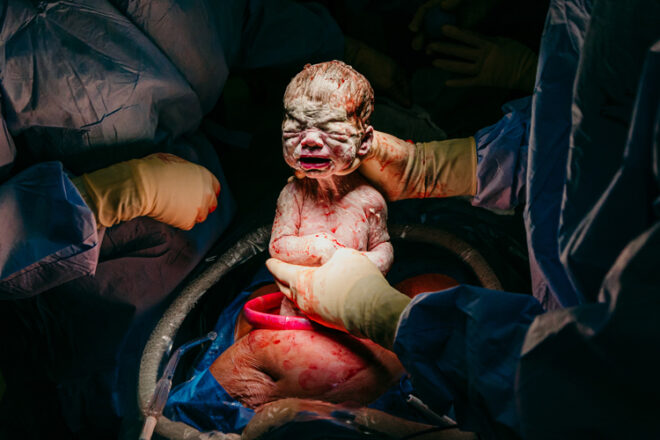 A newborn baby just removed from their mother's stomach
