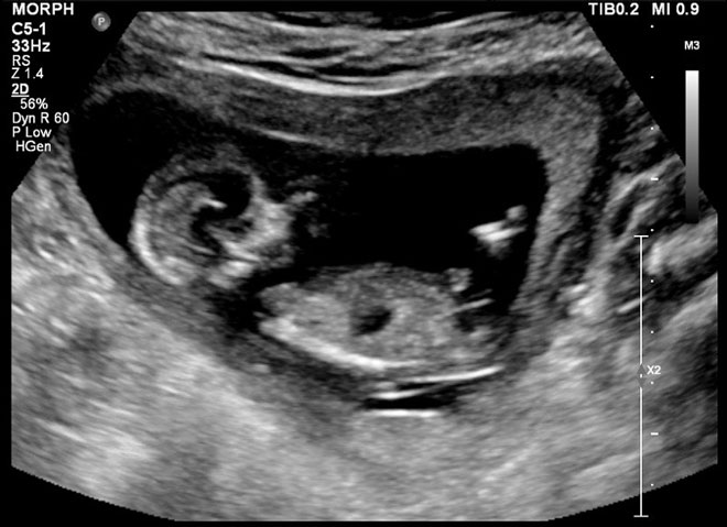 An ultrasound photo