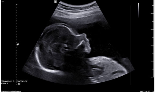 An ultrasound photo of baby