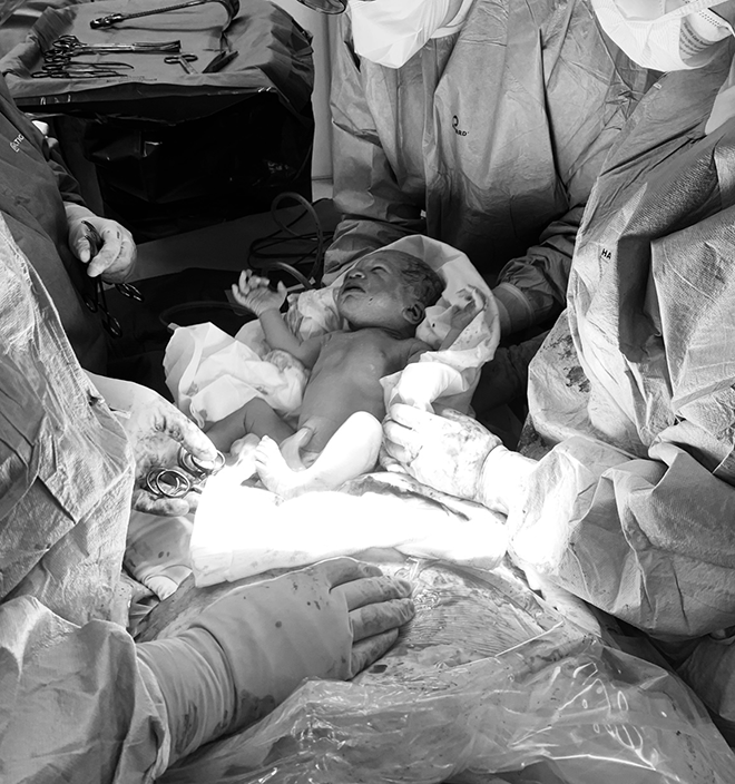 Baby being born during a c-section with doctors and nurses.