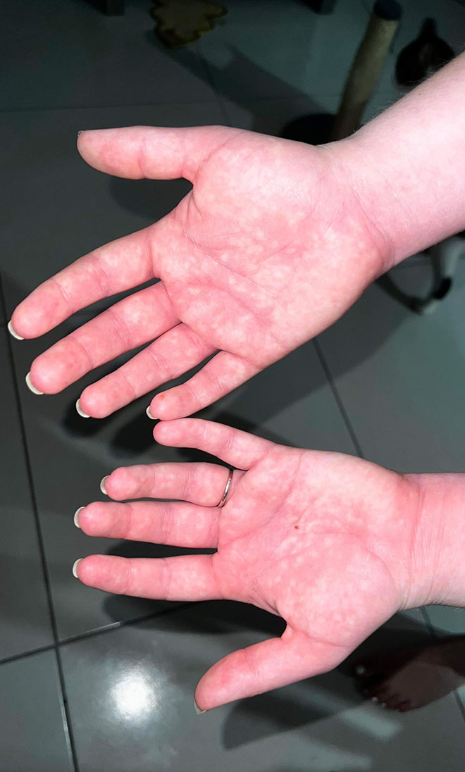 womans hands showing symptoms of Cholestasis of Pregnancy