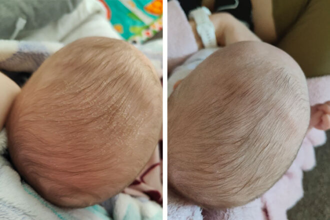 Back of baby's head before and after using the GAIA Cradle Cap Lotion
