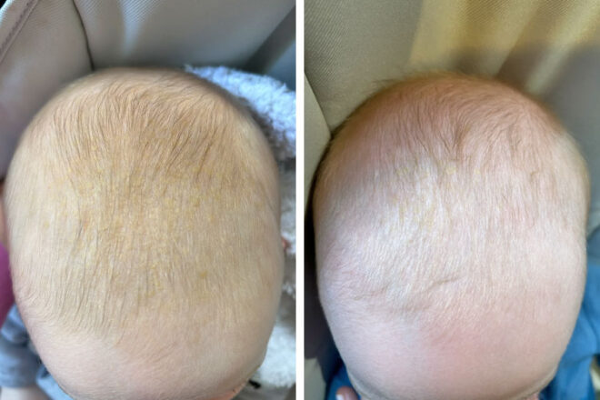 Back of baby's head before and after using the GAIA Cradle Cap Lotion
