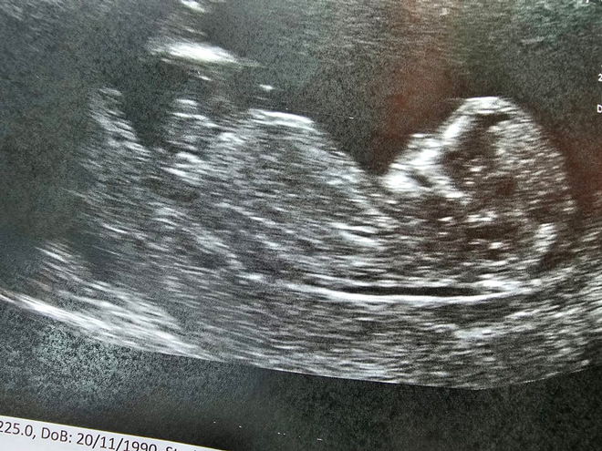 ultrasound pic of baby