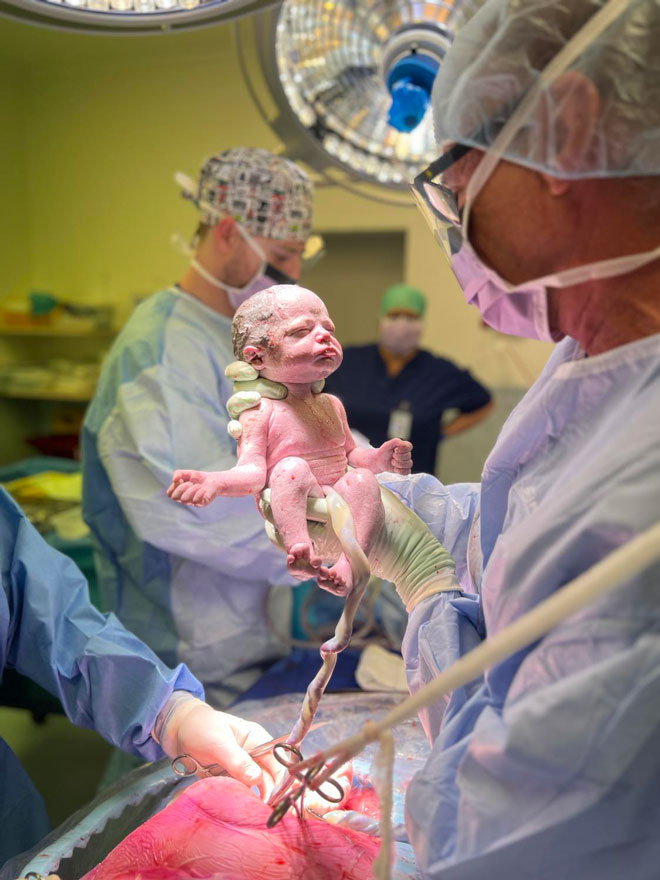 A baby is born via c-section