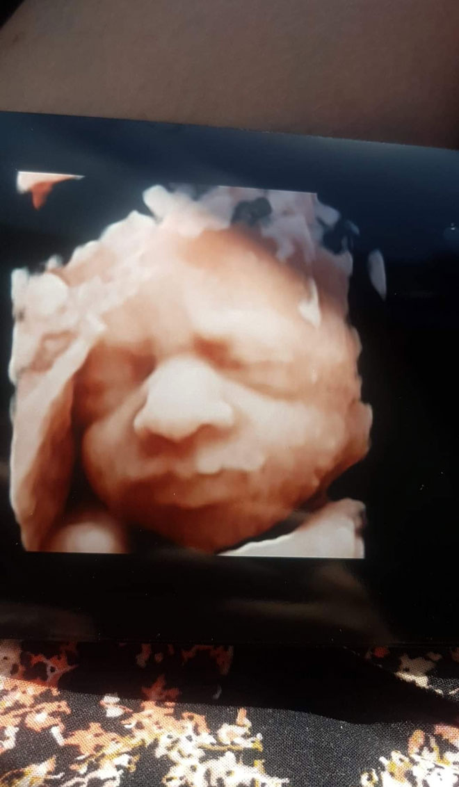 A 4d ultrasound pic