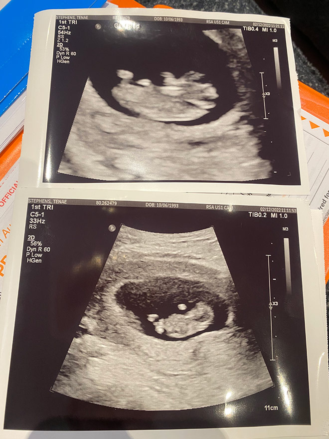 Early ultrasound photos