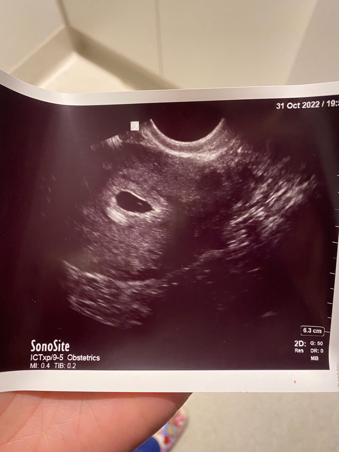 Early ultrasound photo