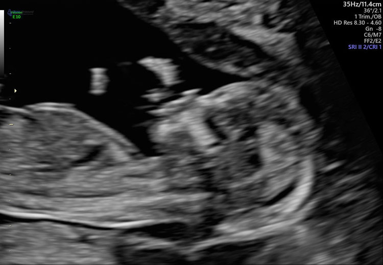 Ultrasound image of Melissa's daughter Imogen