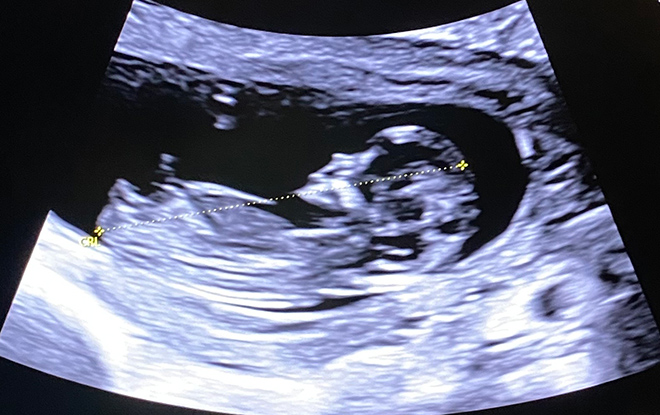 Ultrasound image of baby Teddy 