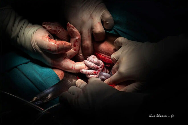 A close up of the moment a baby is being brought into the world via Caesarean section, holding onto the gloved finger of a doctor 